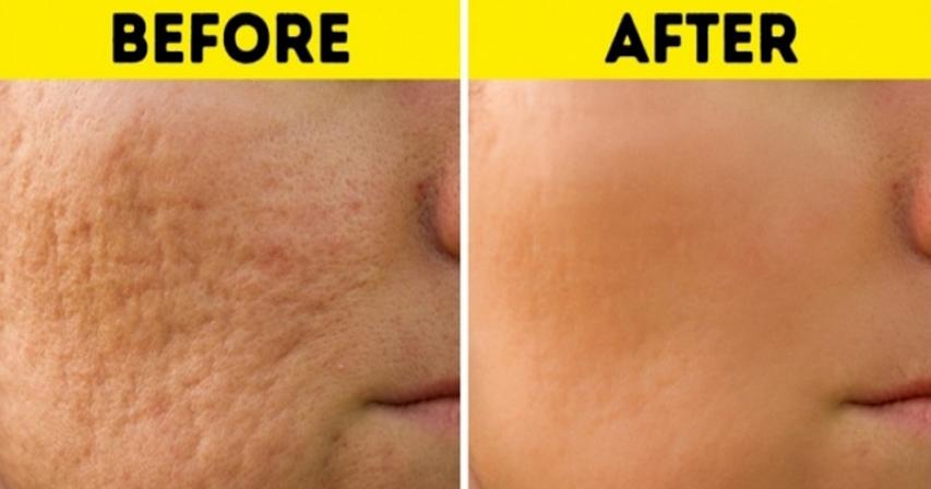 10 Hacks to Remove All Types of Scars and Help Them Heal