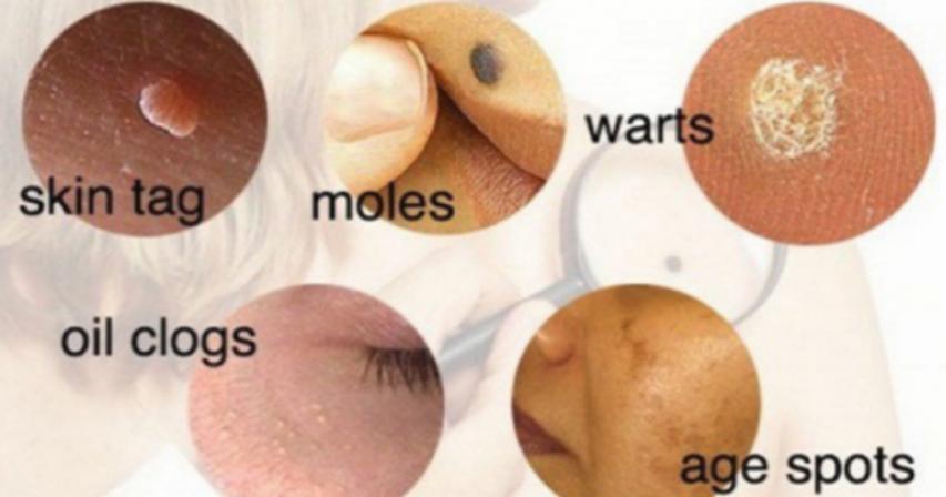 How To Easily Remove Skin Tags, Moles, Blackheads, Spots And Warts By Using Natural Remedies	