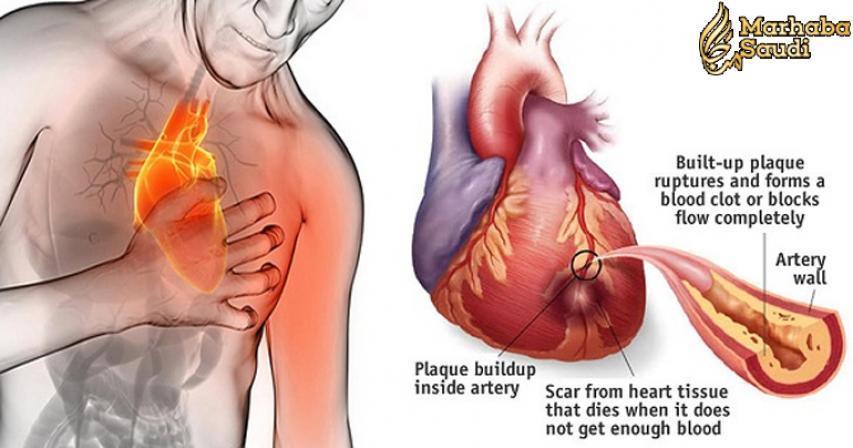 80% of Heart Attacks Could Have Been Avoided with These 5 Things