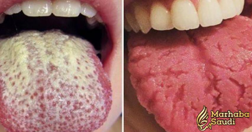 12 Warning Signs Your Tongue May Be Sending About Your Health