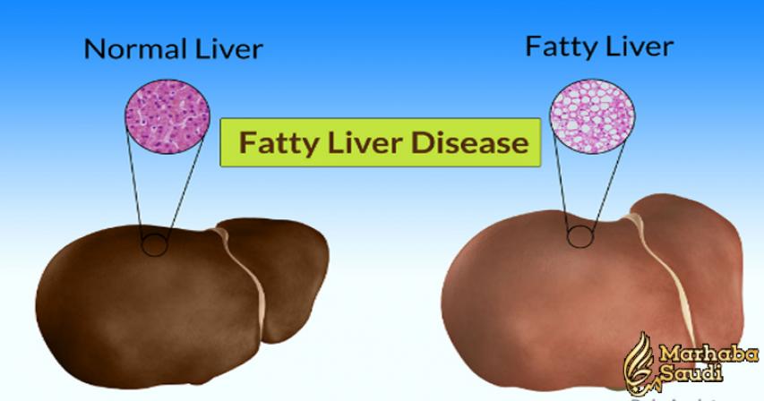 Fatty Liver Disease: 6 Symptoms You Need to Know