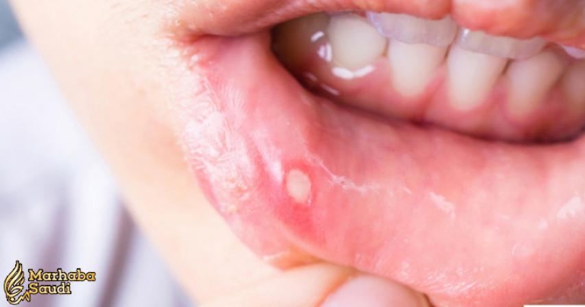 Here is what you can do to treat that mouth ulcer at home