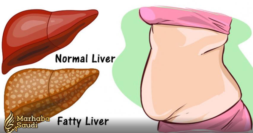 6 Clear Warning Signs Your Liver Is Full Of Toxins And Making You Fat (How to stop it)