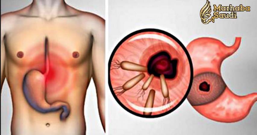 Here is How to Kill the Bacteria that Causes Heartburn and Bloating