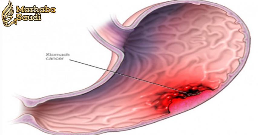 Stomach Cancer: The Most Common Symptoms of this silent killer that you mustn't ignore!