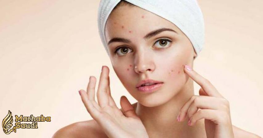 10 Easy and Natural Ways to Get Rid of Acne