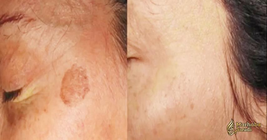 Innovative Treatment Helps Individuals in the UAE Combat Skin Irregularities and Unwanted Tattoos