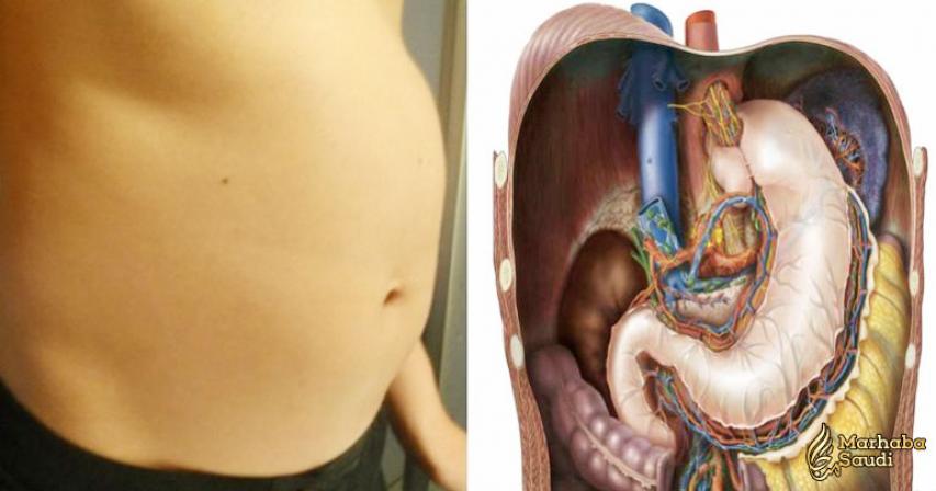 8 Causes Of Bloated Stomach and Natural Remedies