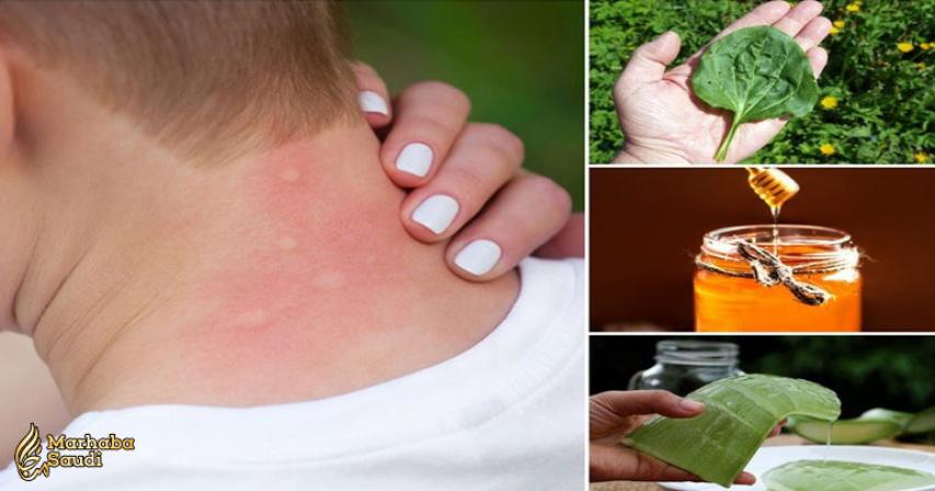 How To Get Rid Of Mosquito Bites: 15 Home Remedies For Instant Relief