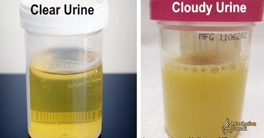 Cloudy Urine: What Does It Mean and Is It a Reason for Concern?
