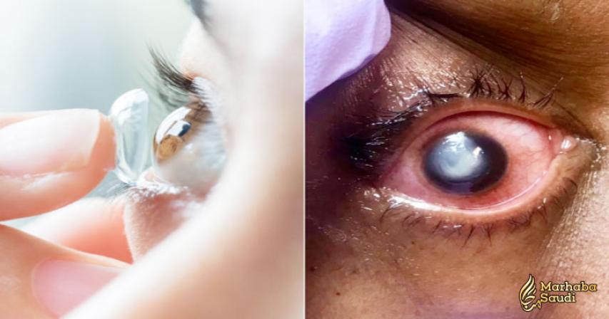 This is why you should NOT sleep in your contact lenses!
