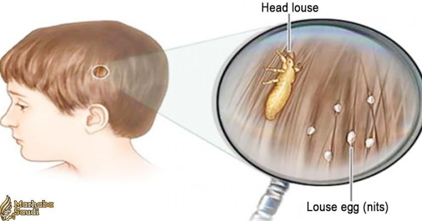 The secret no doctor tells you: This is how you get rid of lice quick and cheap!