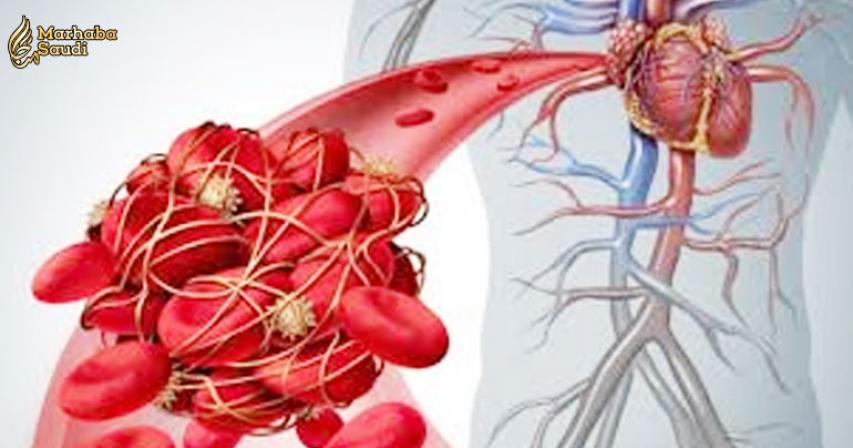 9 Natural Ways to Prevent Blood Clotting and Stroke
