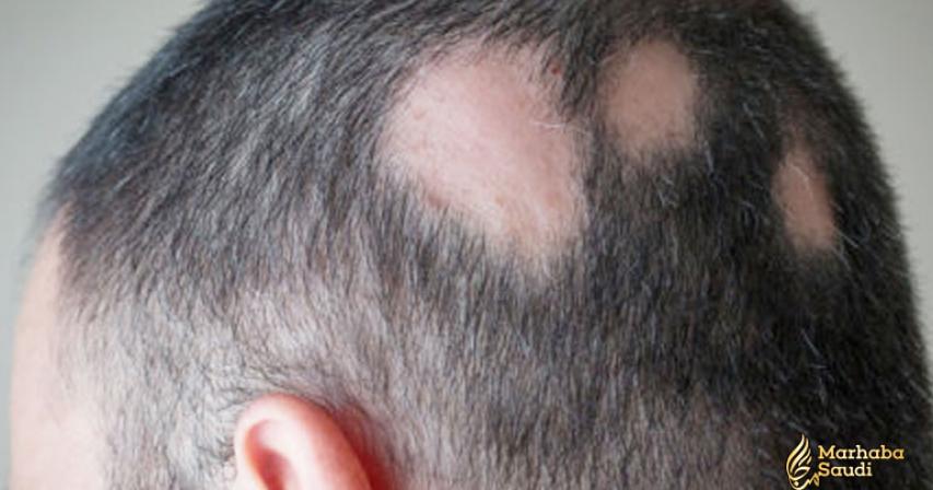 What Is Alopecia? | Alopecia Areata: Causes, Symptoms, And Diagnosis
