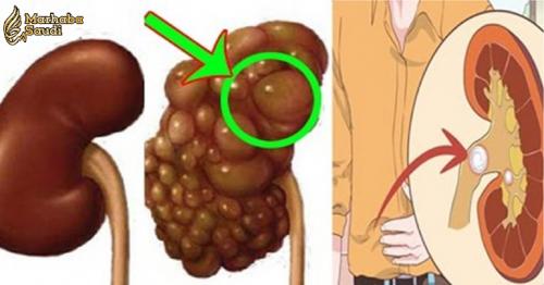 If You Want to Protect Your Kidneys Don't Do These Things!