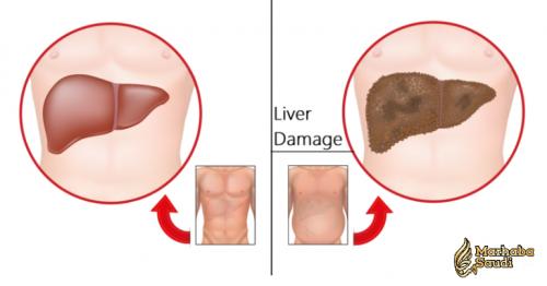 7 Early Warnings of Liver Damage to Never Ignore