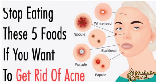 Stop Eating These 5 Foods If You Want To Get Rid Of Acne