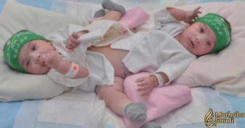 Surgery to separate Saudi conjoined twins postponed