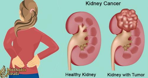 11 Indicators Of Kidney Most Cancers (And Find Out How To Handle It Naturally)