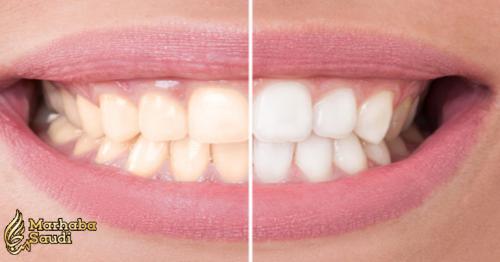 Teeth Whitening: Do it the Professional Way