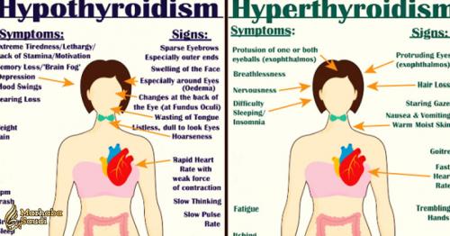 Everything You Need to Know About Every Thyroid Disorder: Signs, Symptoms, Causes, Treatments