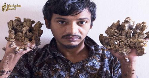 Bangladesh 'Tree Man' wants hands amputated